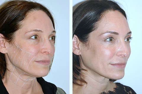 Non-Surgical Facelifts