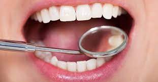 All You Need To Know About Dental Filling